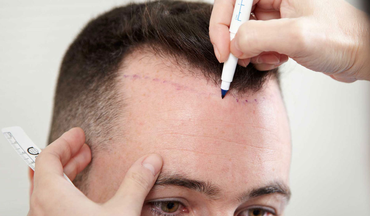 تكلفة زراعة الشعر في تركيا- هتبقى بشعر وبطريقة خياليه 12935