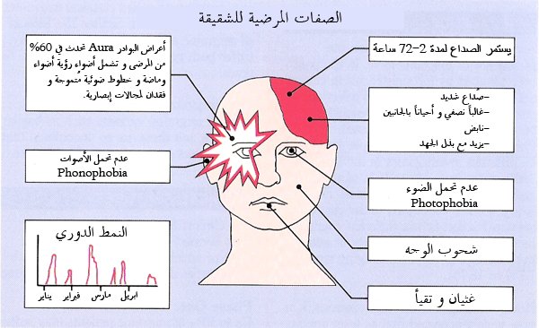 مرض الشقيقة 6623 2