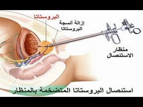 اسباب تضخم البروستاتا - معلومات تعرفها لاول مرة عن البروستاتا 2704 2