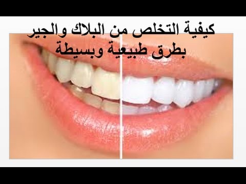 ازالة الكالكير من الاسنان - طريقه سهله لازاله الكالكير من الاسنان 12573 1