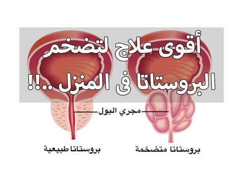 علاج البروستاتا - تعرف على اسباب البروستاتا وكيفية علاجها 2170