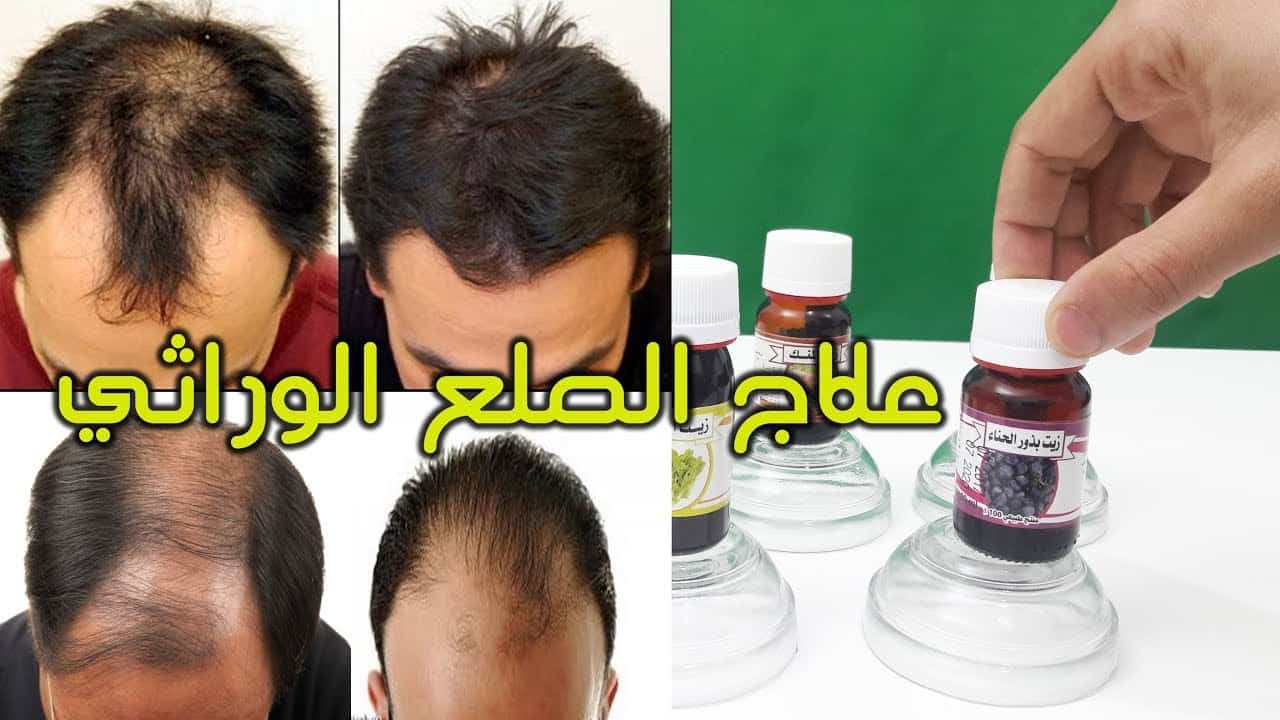 علاج الصلع الوراثي - كيف تعالج الصلع الوراثى 958 2