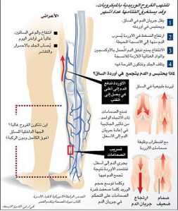 علاج الدوالي - كيفيه الاصابه والعلاج من مرض الدوالى 6374 1