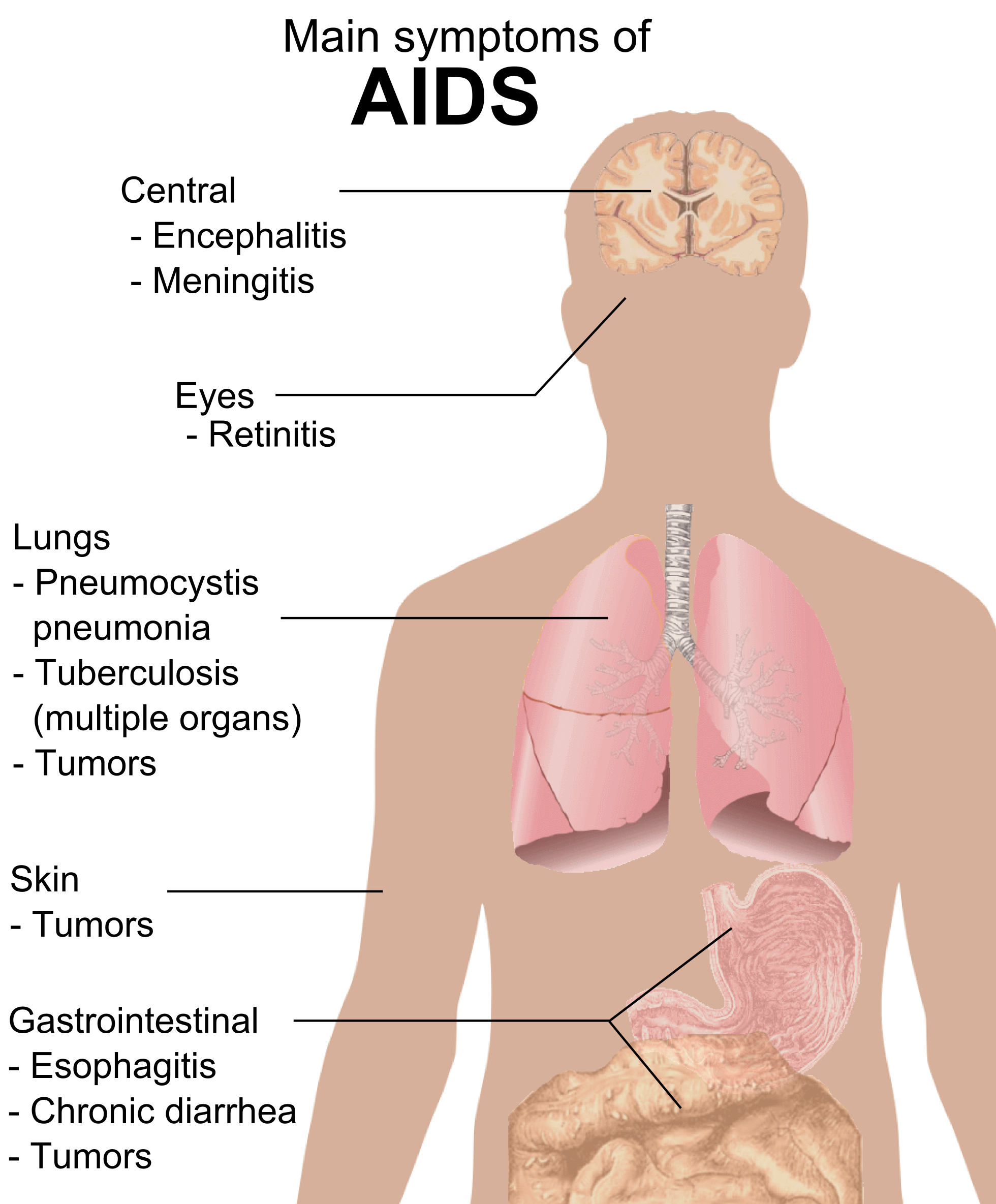 اعراض الايدز , اسباب الاصابه بمرض الايدز