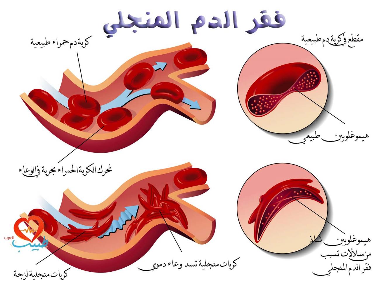 مرض فقر الدم - اعراض فقر الدم 1078