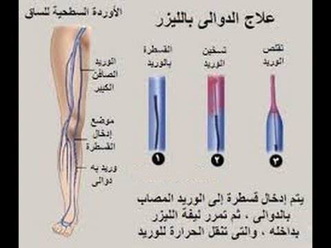 علاج الدوالي - كيفيه الاصابه والعلاج من مرض الدوالى 6374