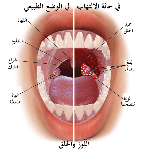 علاج التهاب اللوزتين - ما هي افضل الطرق للتخفيف من الام التهاب اللوزتين وعلاجها 1620 1