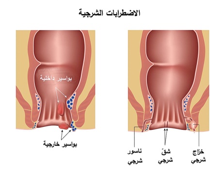 ما هو الناسور - معلومات عن مرض الناسور 3730 3