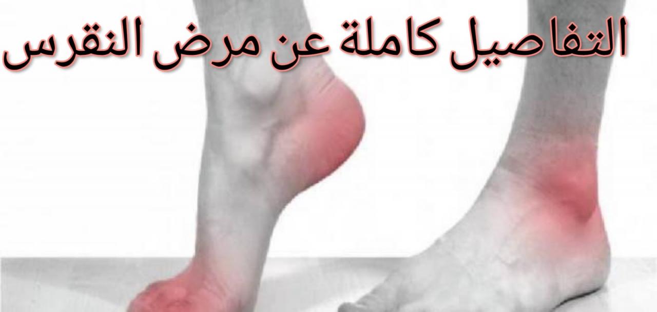 مرض النقرس 4239 2