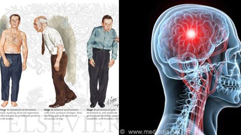 مرض باركنسون - اعراض مرض باركنسون