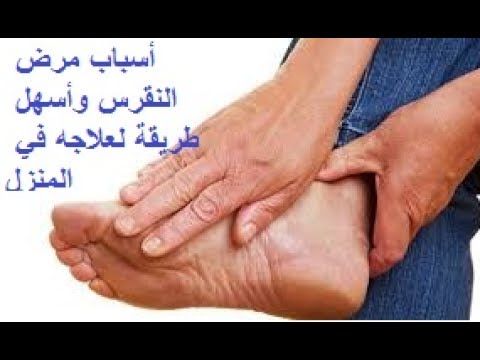 علاج النقرس , الوقاية من النقرس والحماية منه