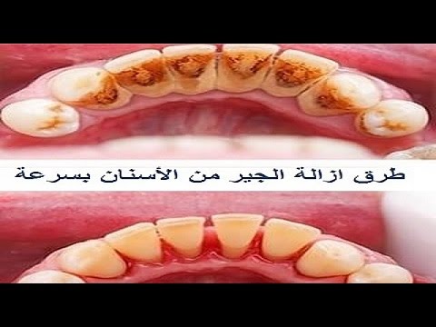 ازالة الكالكير من الاسنان - طريقه سهله لازاله الكالكير من الاسنان 12573 2