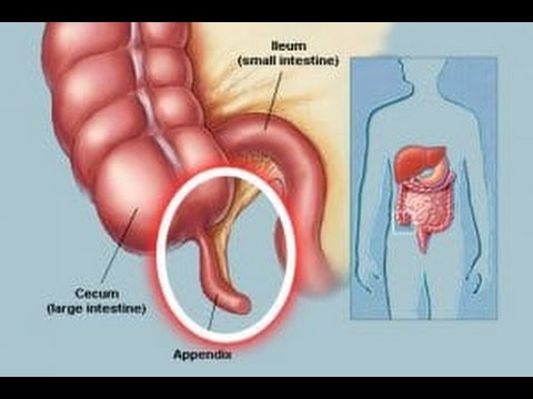 الزائدة الدودية - شكل الزائده الدوديه 0 56