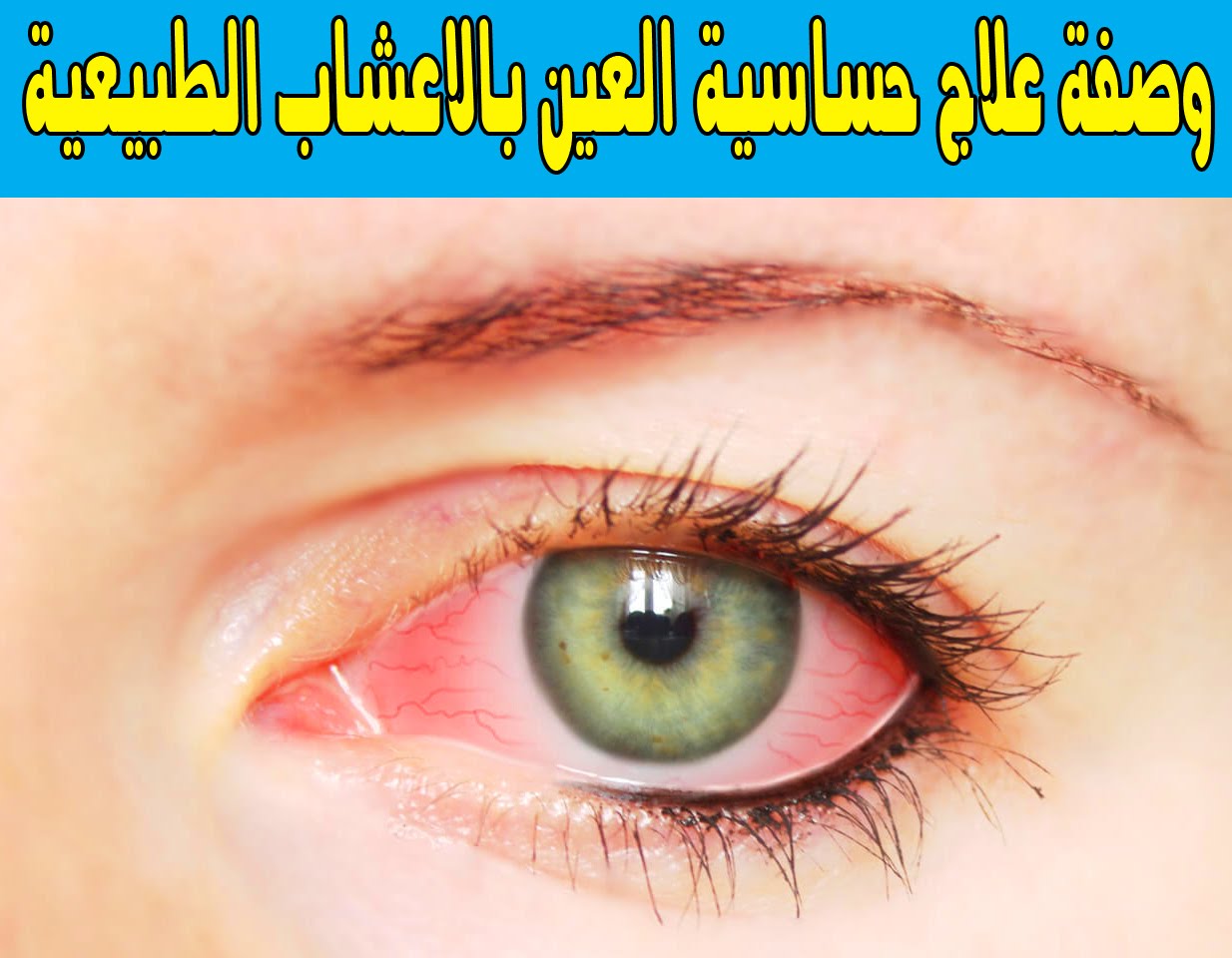 علاج حساسية العين - كيفيه التخلص من حساسيه العين 6391 3