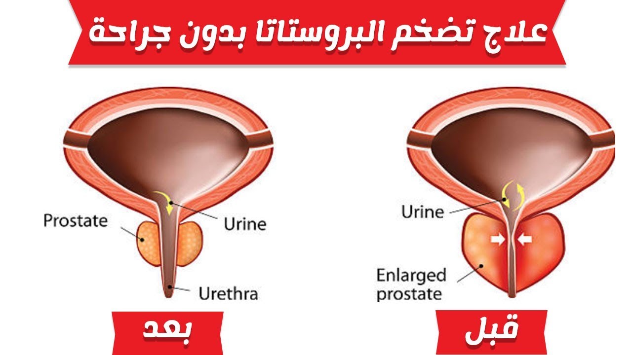 علاج البروستاتا - تعرف على اسباب البروستاتا وكيفية علاجها 2170 2