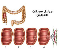 اعراض سرطان القولون , تعرف على خطورة سرطان القولون