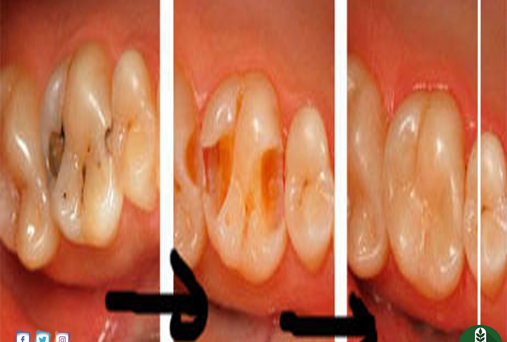علاج تسوس الاسنان - طرق فعالة لمشاكل الاسنان 1038 3