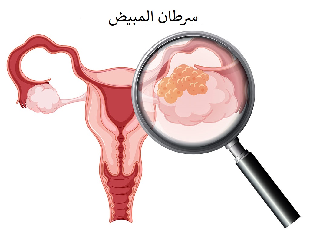 علاج سرطان المبيض , دورت علي علاج كتير لغايه ما عرفت ده