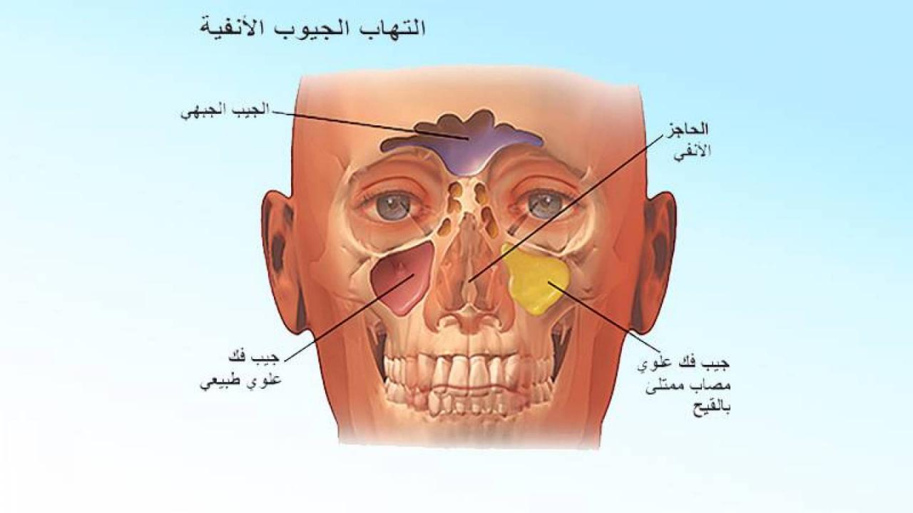 علاج تضخم الجيوب الأنفية- التهاب الجيوب الانفيه وعلاجها 12431 3