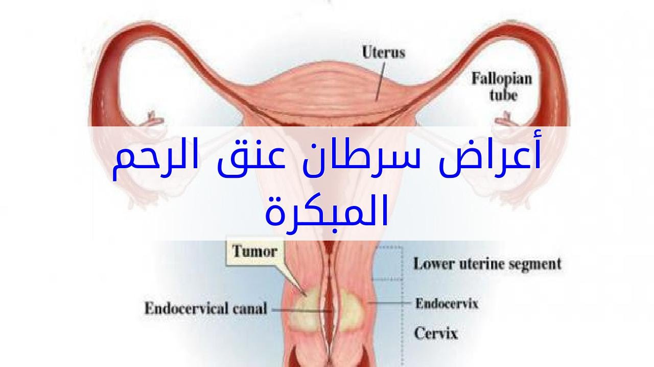 اعراض سرطان الرحم