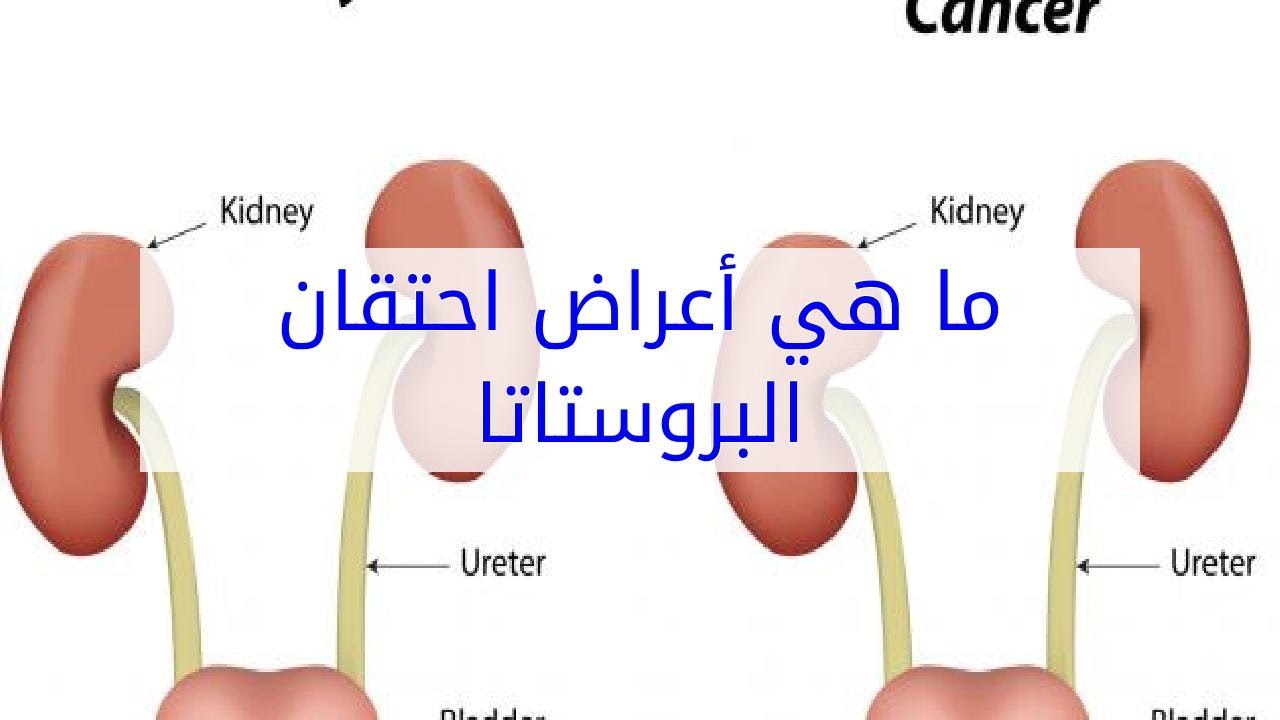 اعراض البروستاتا , اسباب الاصابه بمرض البروستاتا