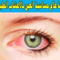 6391 3 علاج حساسية العين - كيفيه التخلص من حساسيه العين شهد