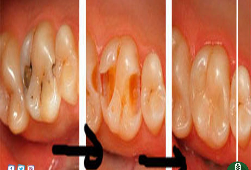 علاج تسوس الاسنان , طرق فعالة لمشاكل الاسنان - صور بنات