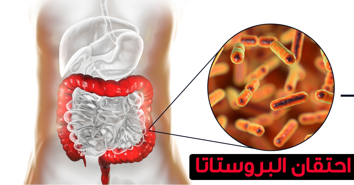 علاج تضخم البروستاتا